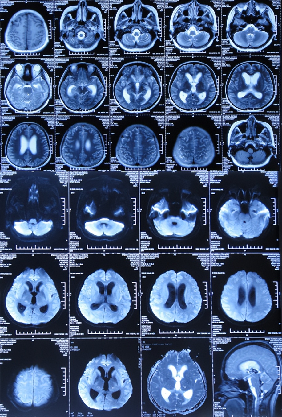 结核性脑积水能治愈吗,儿童结核脑膜炎脑积水