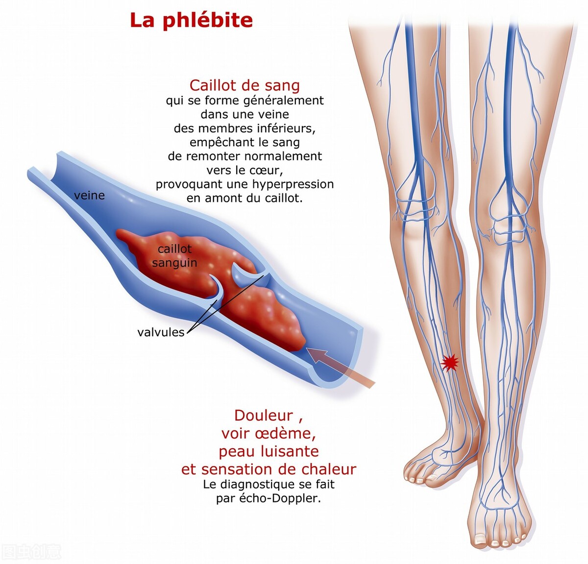 下肢肿胀警惕深静脉血栓形成,下肢静脉血栓看心血管内科