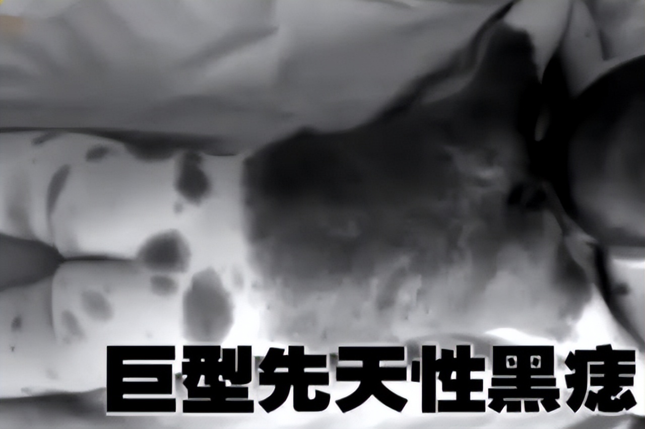 2010年河北行唐，儿子患病身长“巨型黑痣”，母亲为救子割皮移植