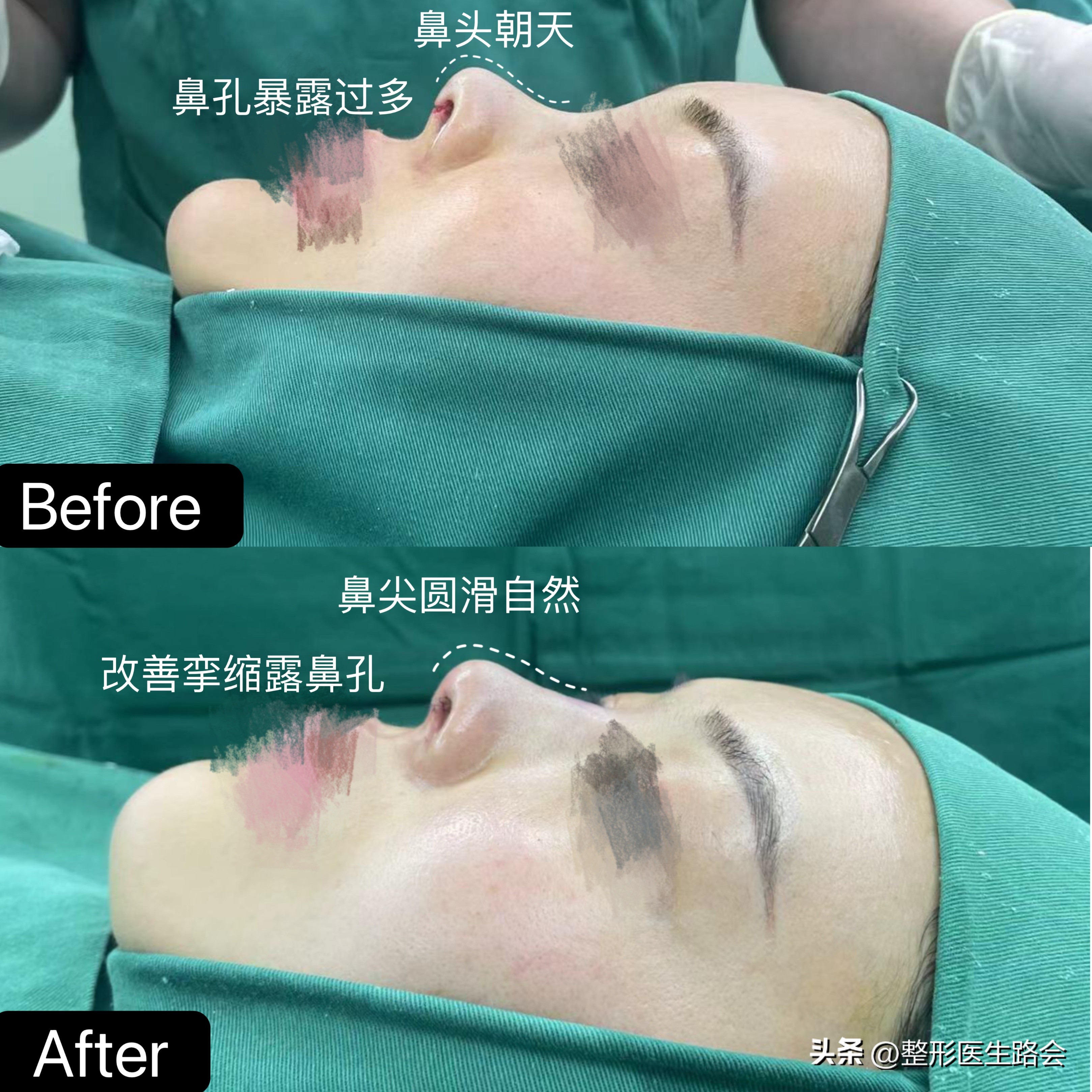 你对隆鼻整形有什么看法,鼻部整形大家最关心的话题