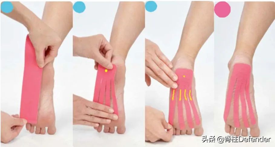 足跟痛筋膜炎最佳的治疗方法,足跟痛和足底筋膜炎康复治疗