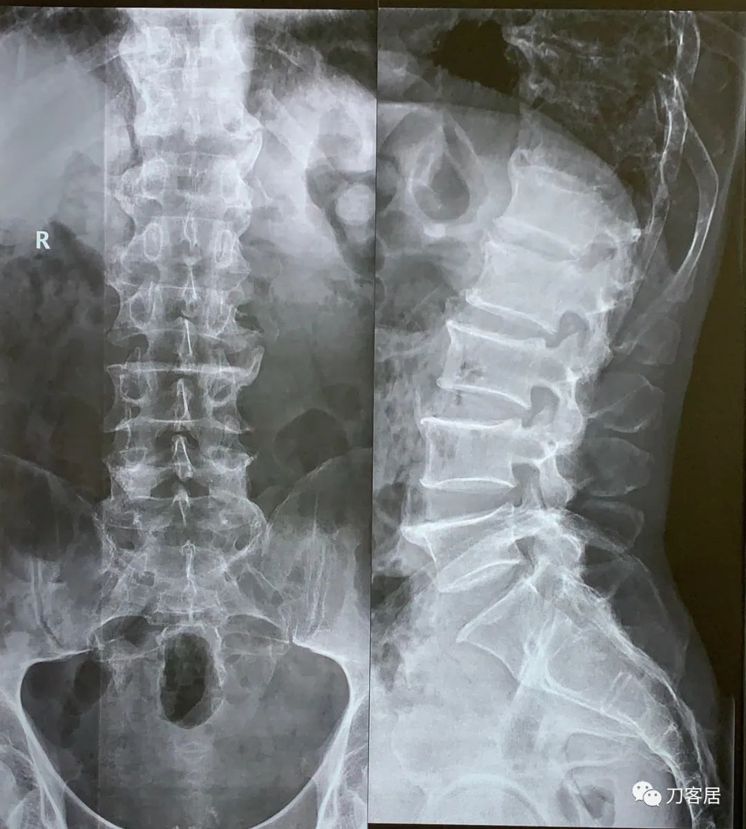 髋部疼，小腿肚胀、抽筋，折腾了5年没效果，能用阿仑膦酸钠吗？