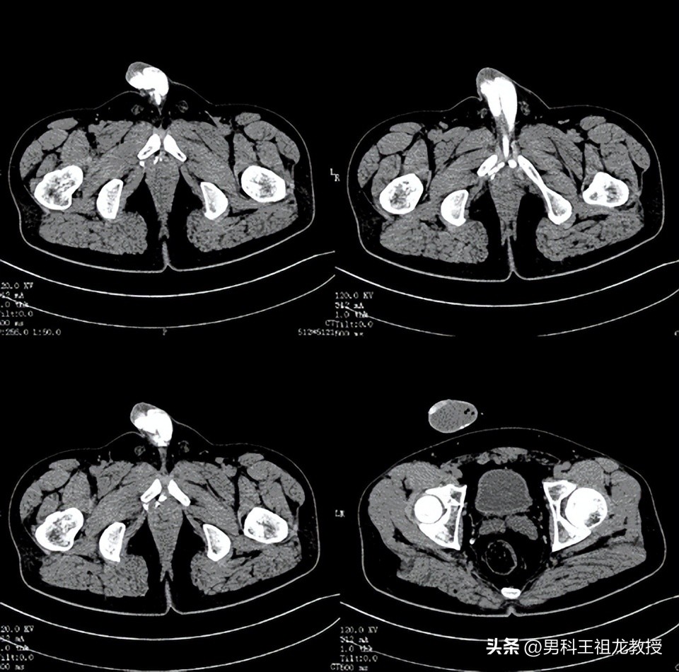 我院男科，完成首例CT下阴茎海绵体造影及三维血管重建手术！