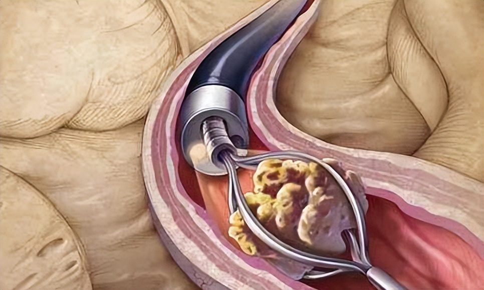 输尿管结石的饮食禁忌事项介绍,胆囊结石微创手术后饮食禁忌