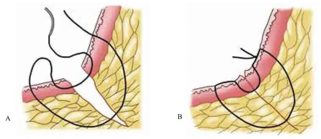 3分钟get:真正的外科缝合秘籍