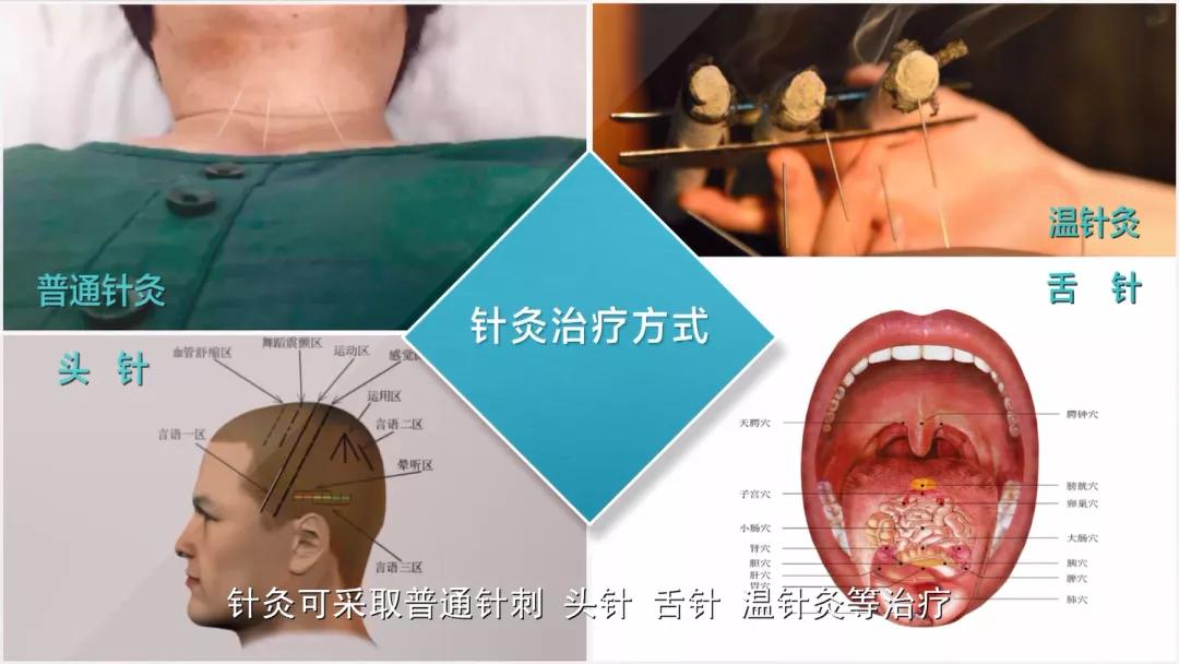 甲状腺术后患者知识宣教,甲状腺术后声音嘶哑康复训练措施