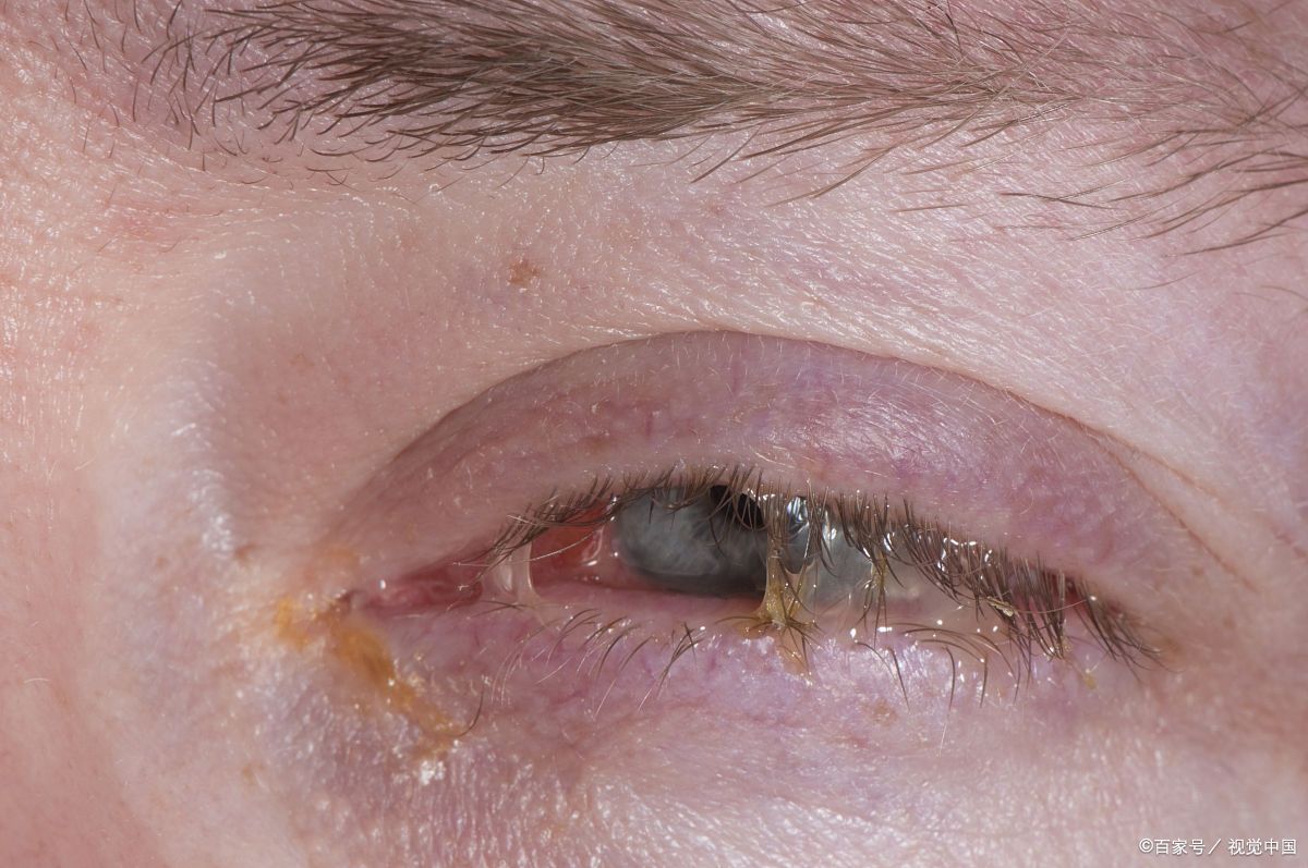 小孩突然眼屎多是什么原因引起的,三岁宝宝眼屎多眼睛肿是什么原因