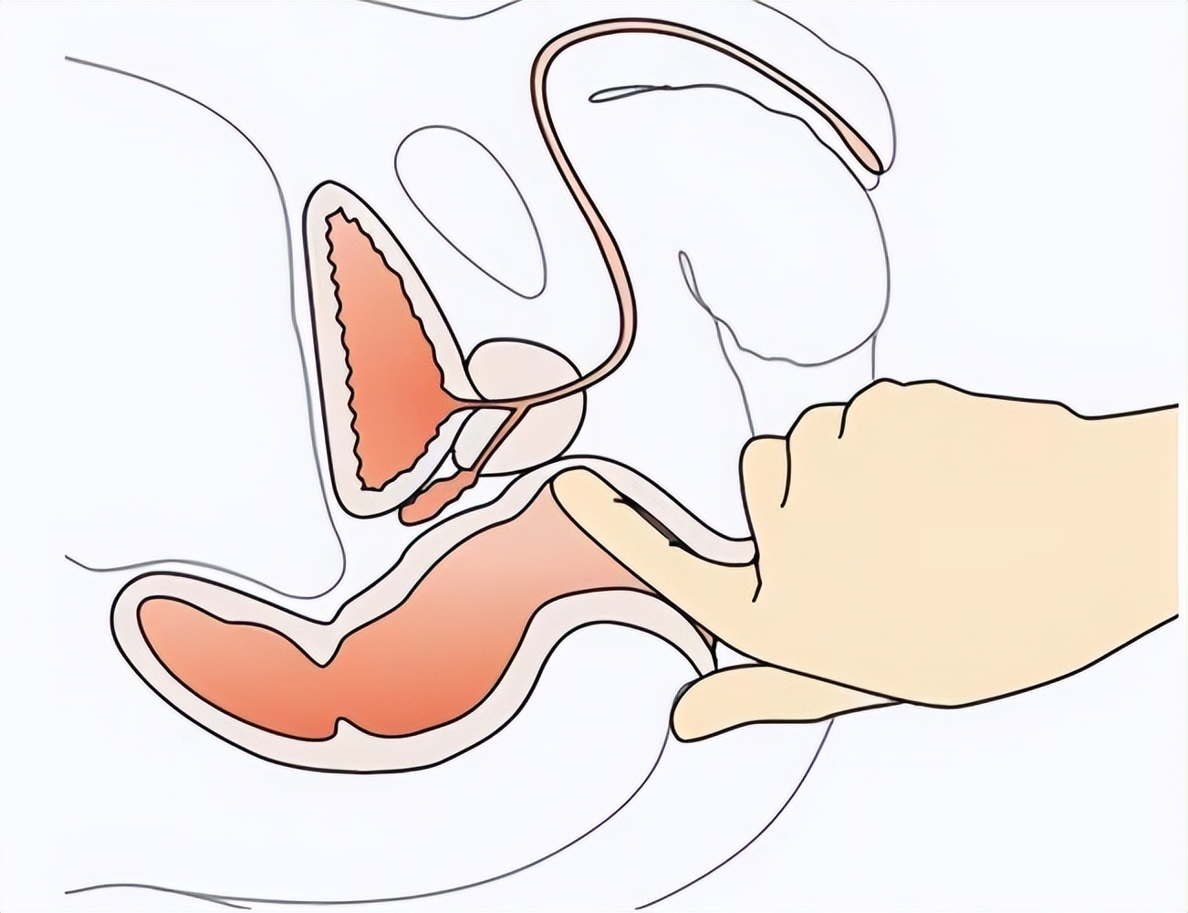 男中老年前列腺都有什么症状,老年人前列腺癌有哪些症状