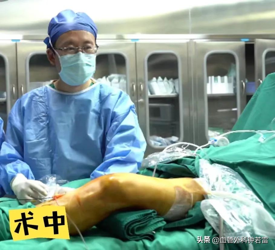 【静脉曲张案例34】61岁尹阿姨腿抽筋睡不着微创清零“小蚯蚓”