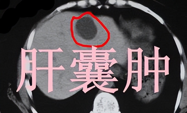 多发肝囊肿吃什么药能消除,肝囊肿疼吃什么药能消除