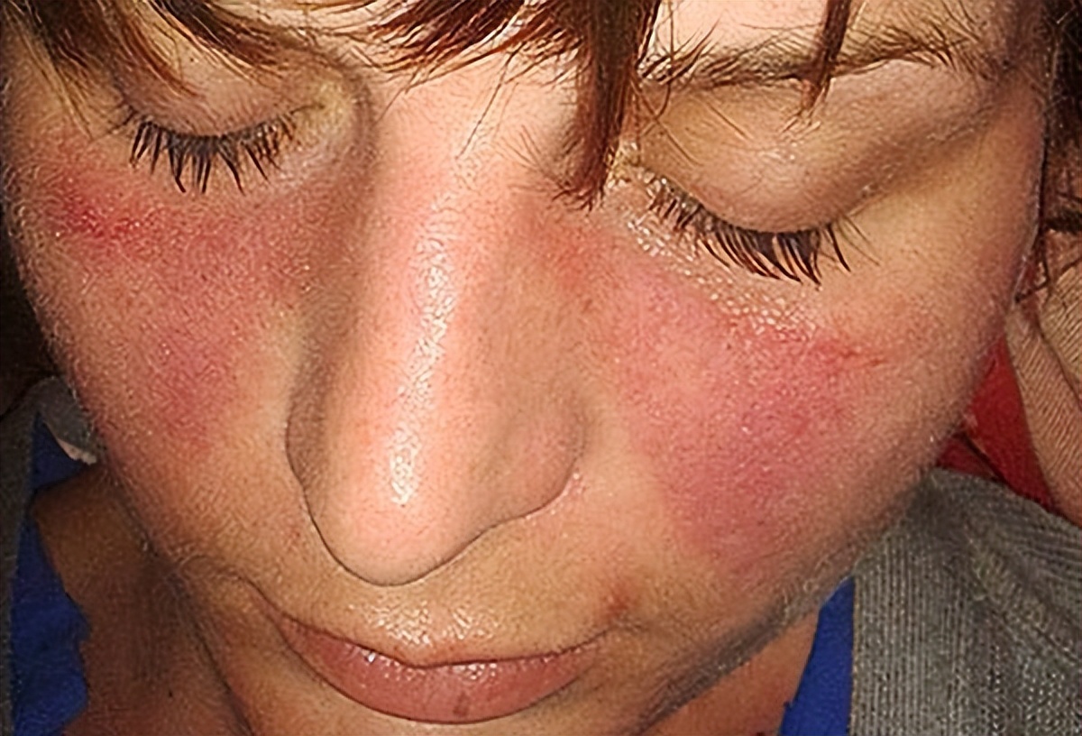 狼疮性肾炎吃药多久尿蛋白转阴,女性狼疮