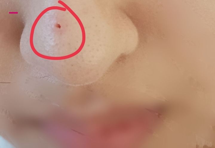 鼻子黑头挤出水一样的液体,鼻子挤黑头粉刺