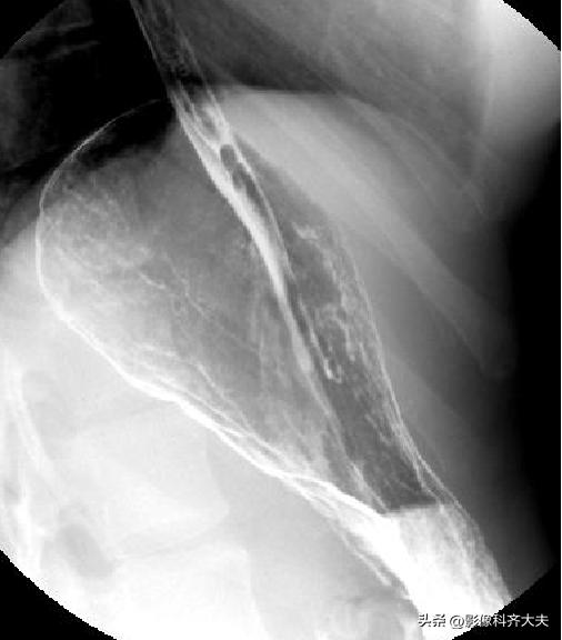 胃肠道造影超声解剖图,胃肠钡餐影像检查片子