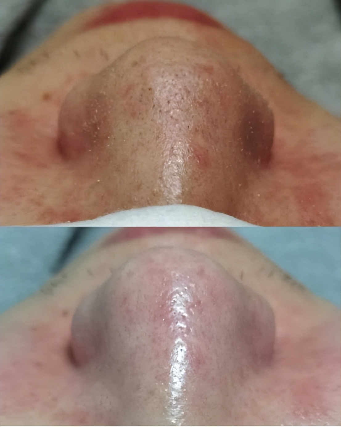 鼻子上好多黑头把毛孔堵住了,鼻子上的黑头怎么去除最有效方法