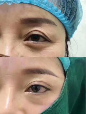 九院面部年轻化有哪些项目,40岁做什么医美项目可以提升脸部