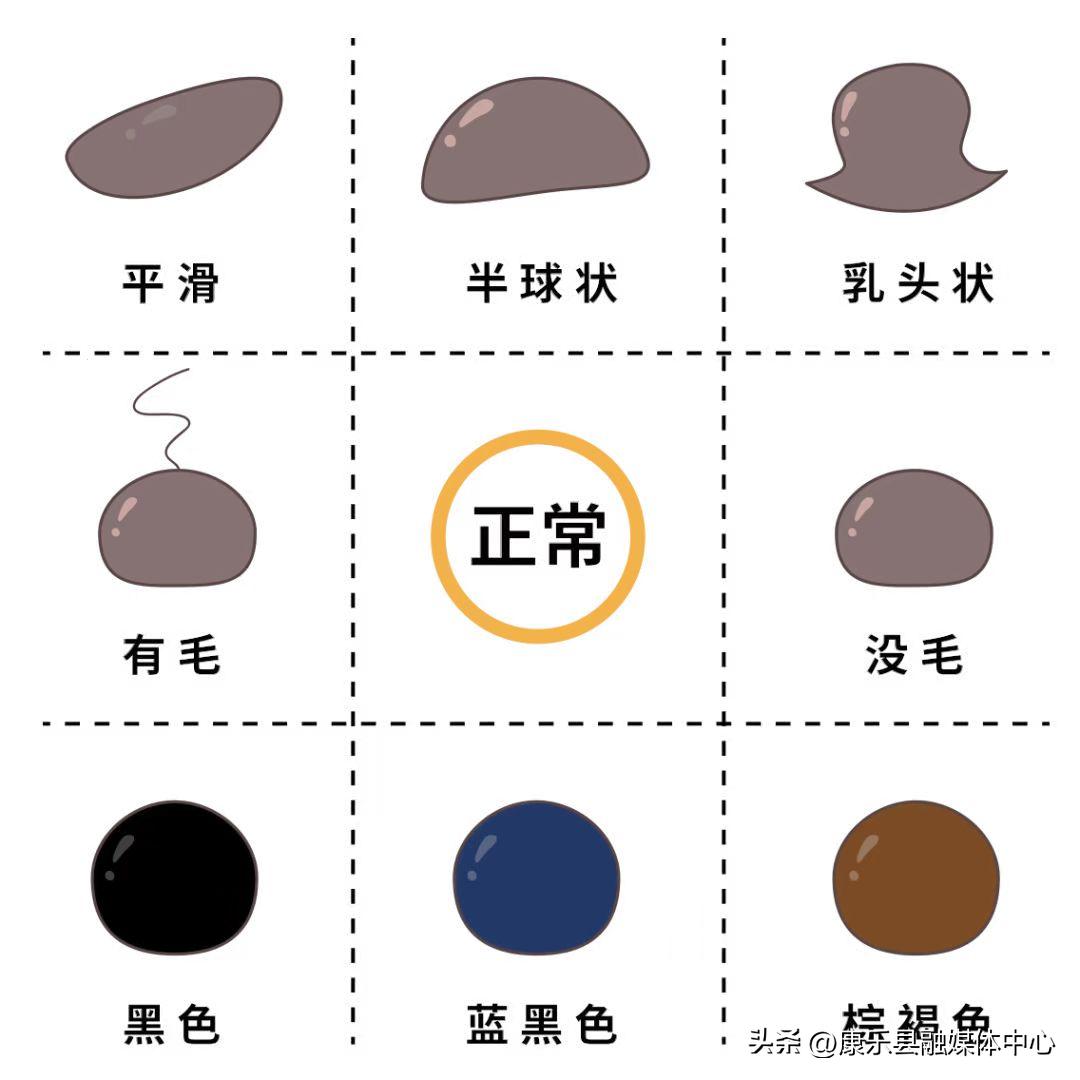 后天长的痣可以随便点掉吗,长在脸上哪些痣不能点