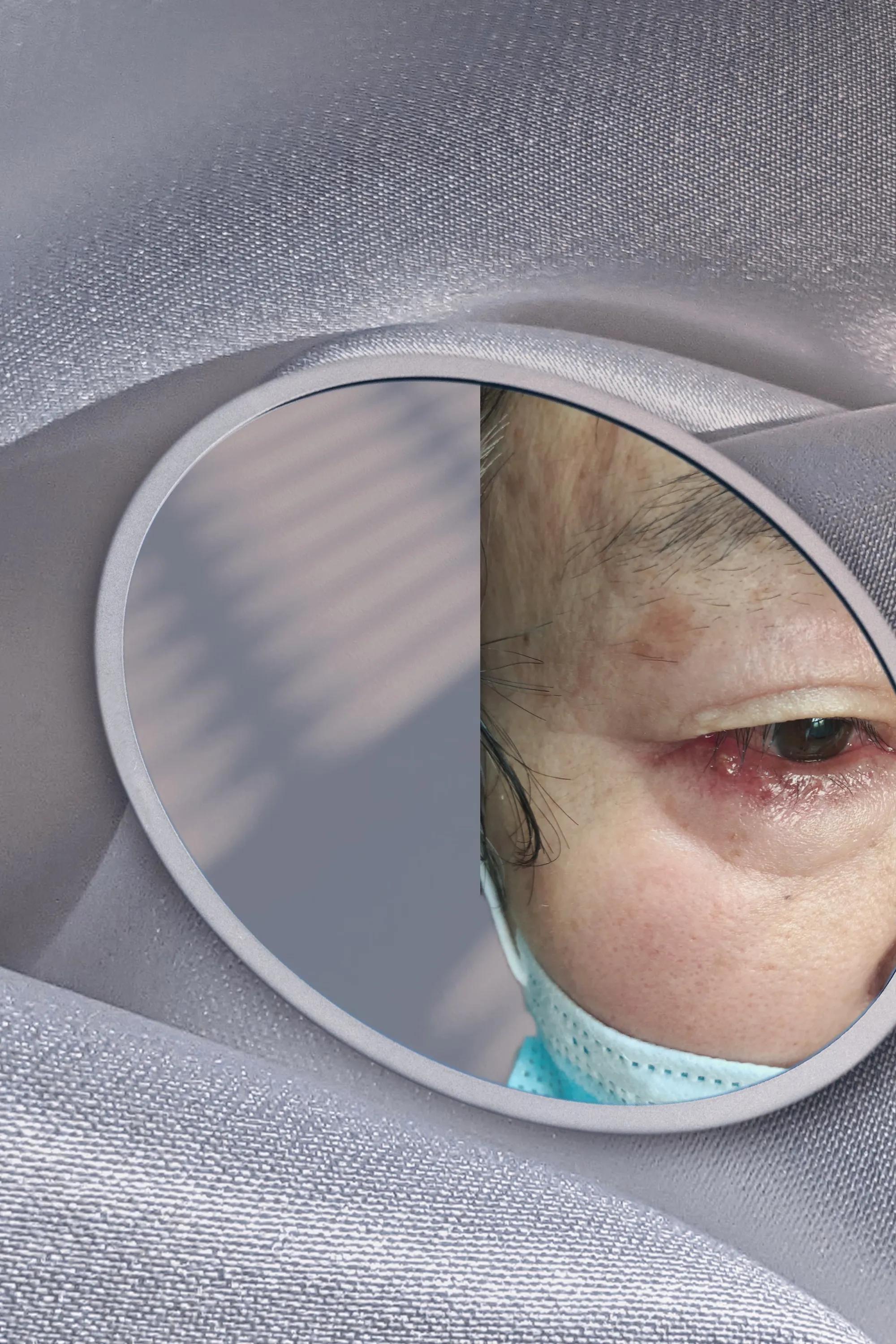 带状性疱疹能除根吗,带状疱疹有自限性是什么意思