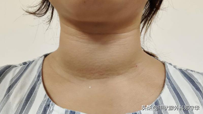 十个甲亢患者，九个有这个坏习惯，赶快自查