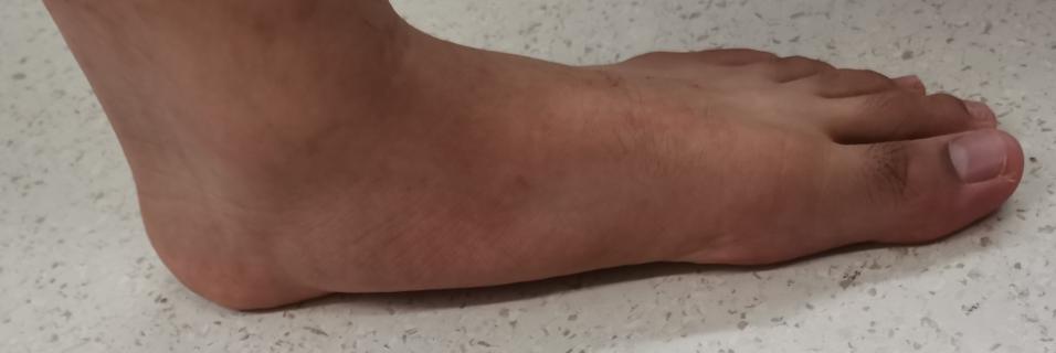 距下关节制动术成人效果如何,距下关节制动器作用