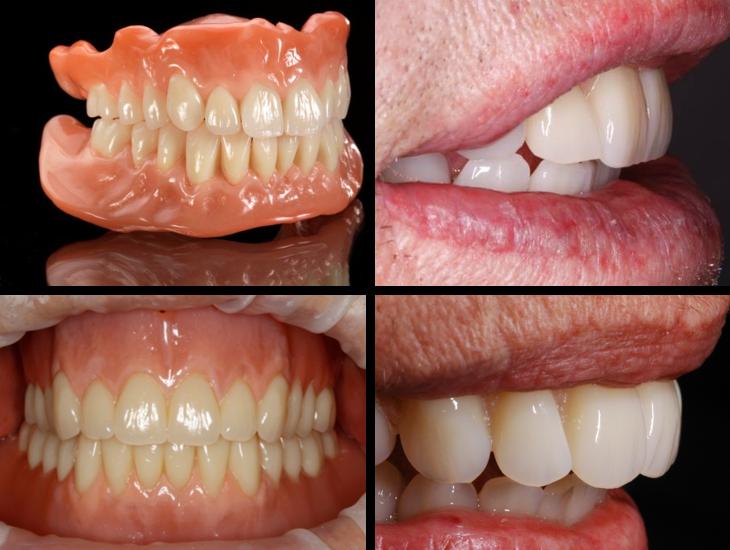 老人假牙的种类及价格,假牙的种类及价格你知道吗