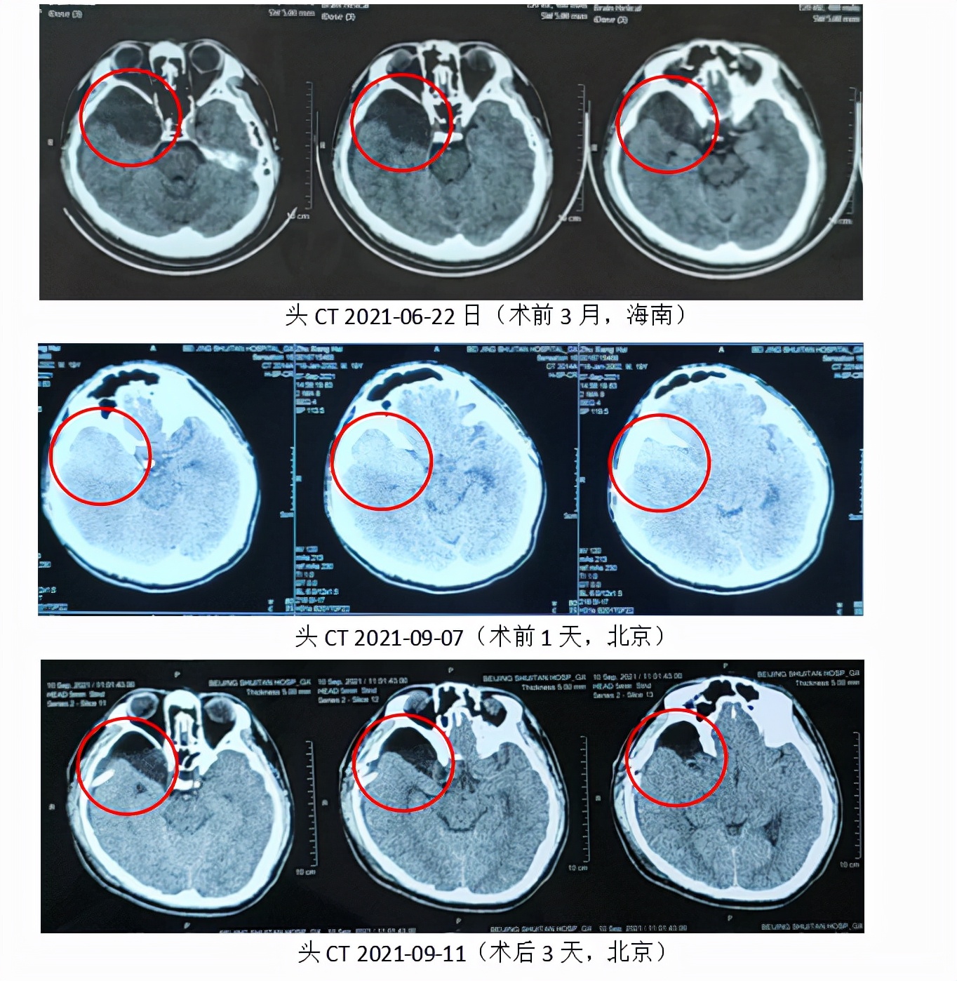蛛网膜囊肿引起硬膜下血肿,蛛网膜囊肿造瘘术后硬膜下血肿