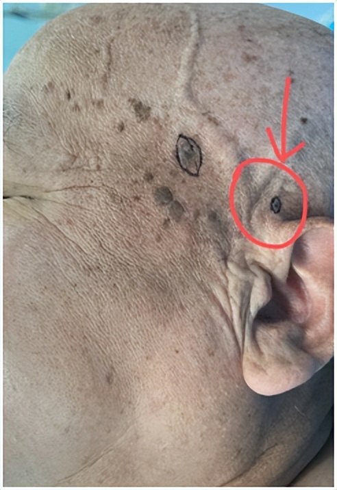 谈痣色变,身上长的痣都是色素痣吗