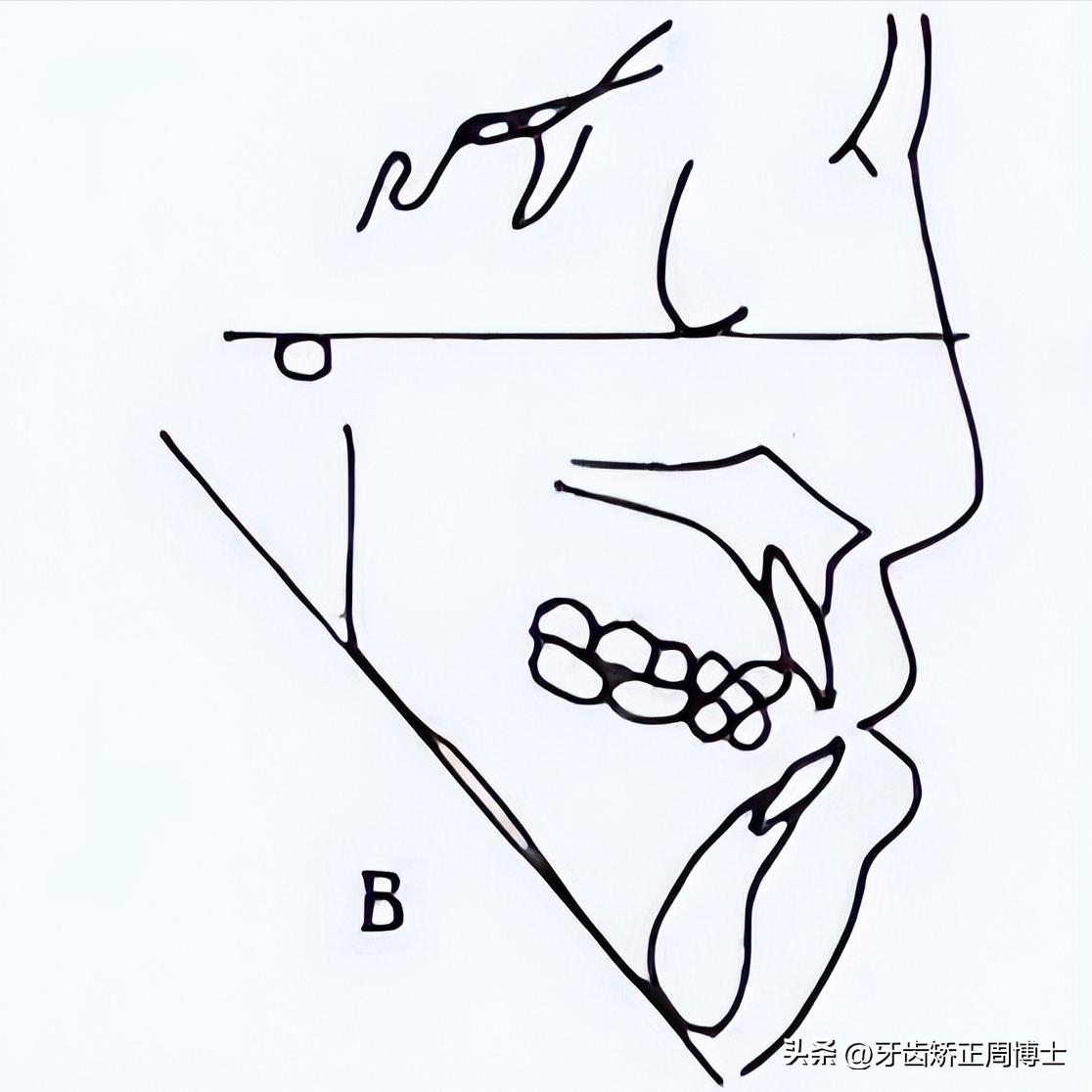低角面型下巴前倾正畸案例,露龈笑嘴凸下巴后缩