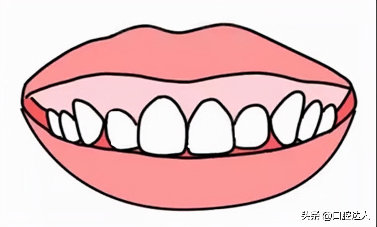 打骨钉改善露龈笑多久能看到效果,露龈笑是天生的吗