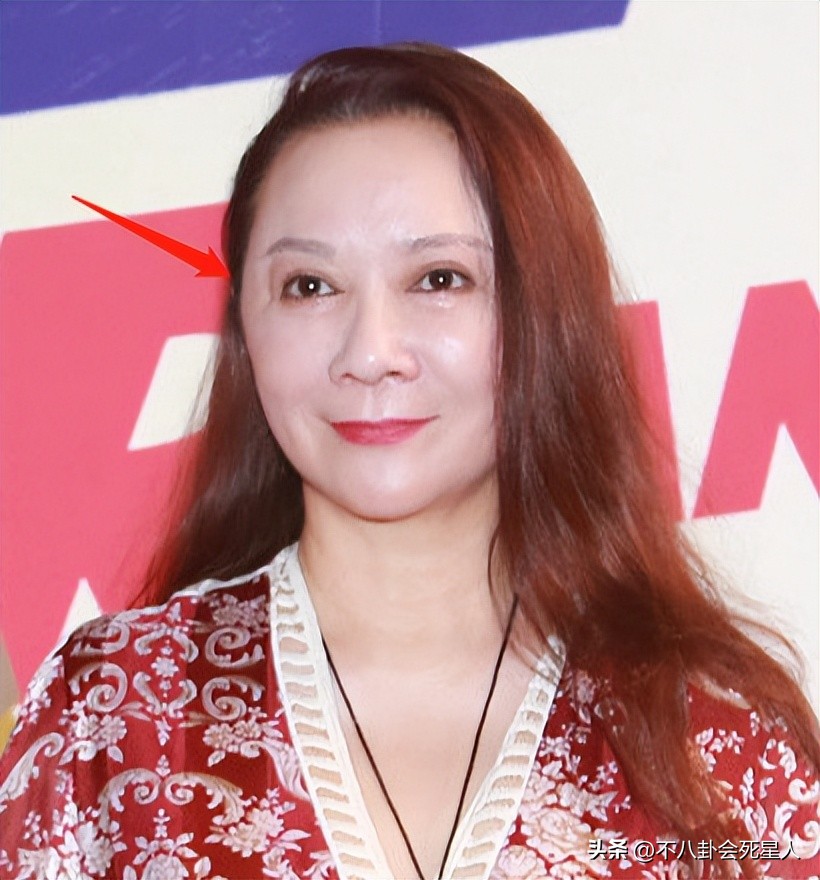 拉皮的女明星后遗症,拉皮失败的明星