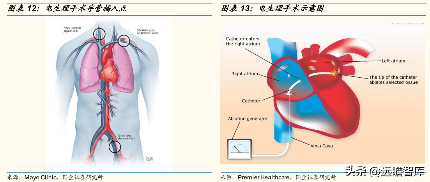 专注电生理介入诊疗，微电生理：市场高速成长，国产替代空间巨大