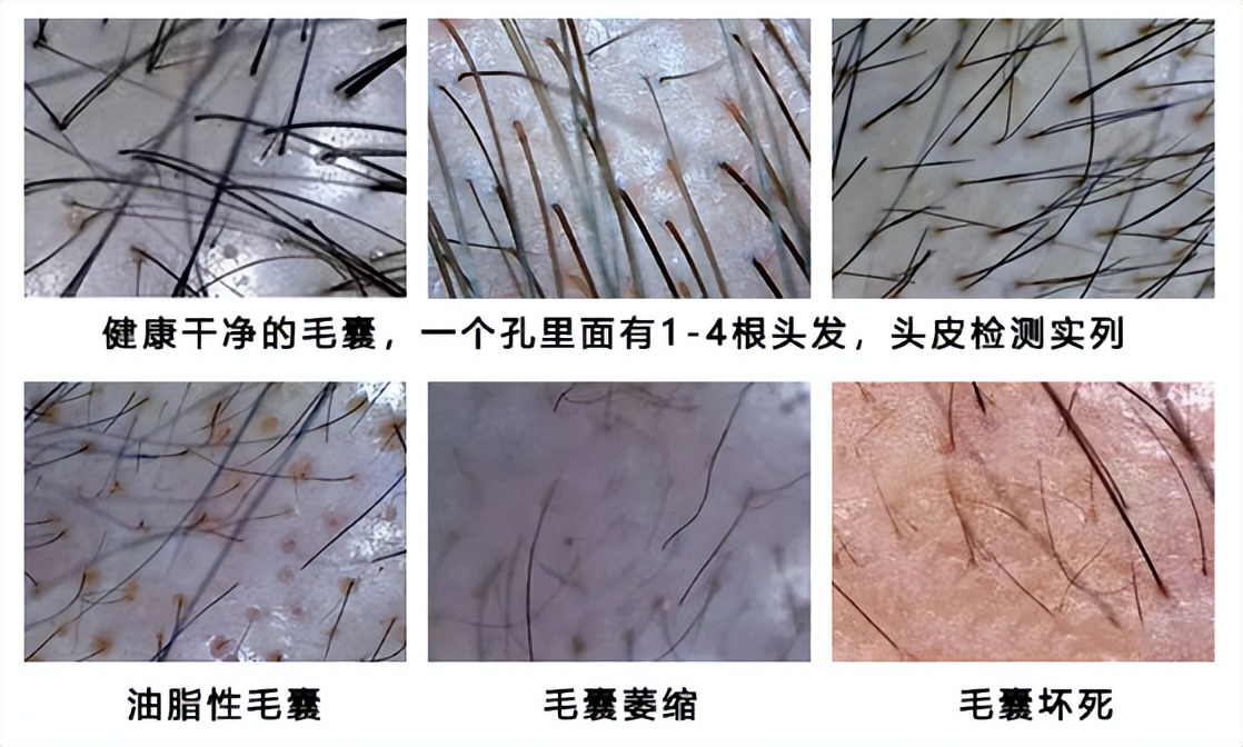 脂溢性脱发如何生发有哪些技巧,脂溢性脱发如何治疗生发