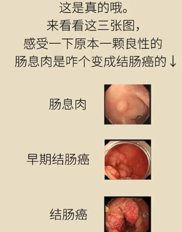 肠长了息肉会有啥症状,肠内为什么容易长息肉