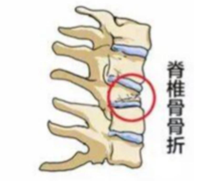 骨质疏松性骨折最常见的部位,发生骨质疏松骨折最常见的部位