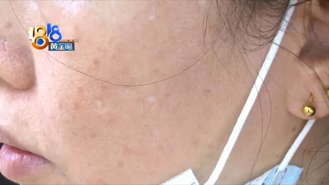 顾客说点痣后留坑怎么回复,激光点痣太深留下坑