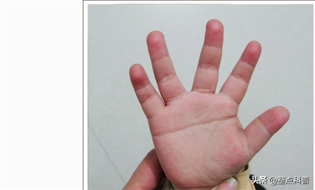 民间断掌纹说法,断掌纹与先天疾病