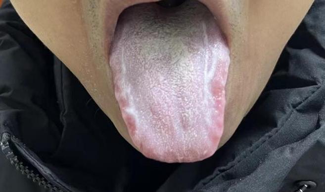 重庆江北中医院调理湿气,重庆市中医院专治体内湿气重