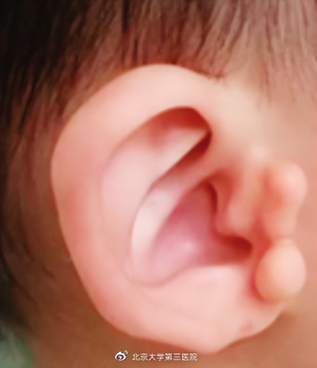 眼底有颗黄豆大小的瘤子可怕吗,眼睛里有一块褐色的斑块图片