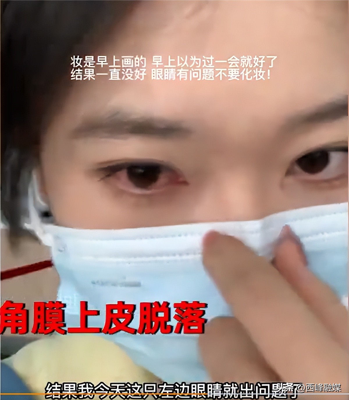 女子熬夜玩手机角膜穿孔,角膜上皮脱落熬夜