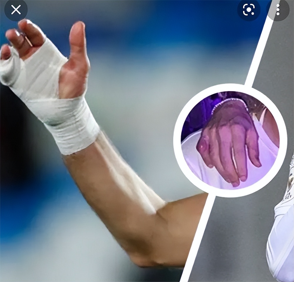 本泽马手上的绷带是什么绷带,本泽马的手绷带怎么打