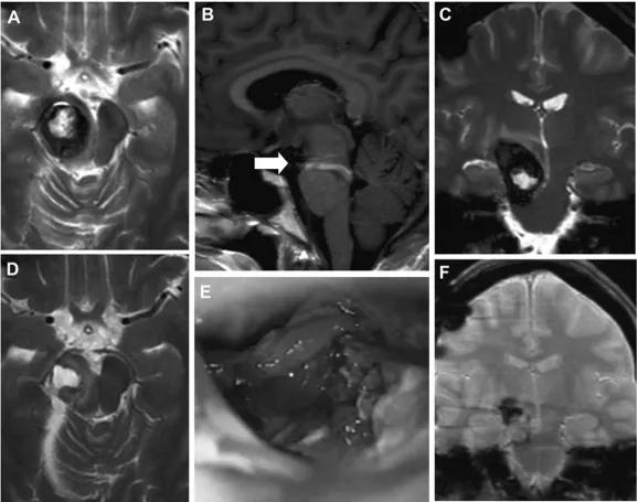 孕妈妈被查出癌症,孕妈妈怀双胞胎又得了肿瘤视频