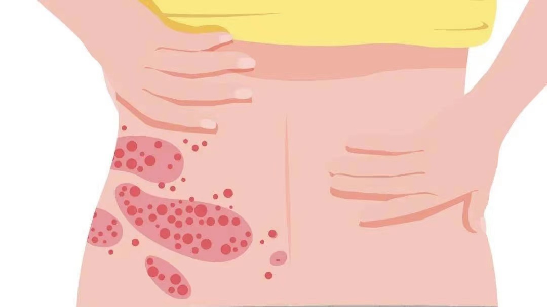 带状疱疹生蛇疼起来要人命,带状疱疹会要人命吗