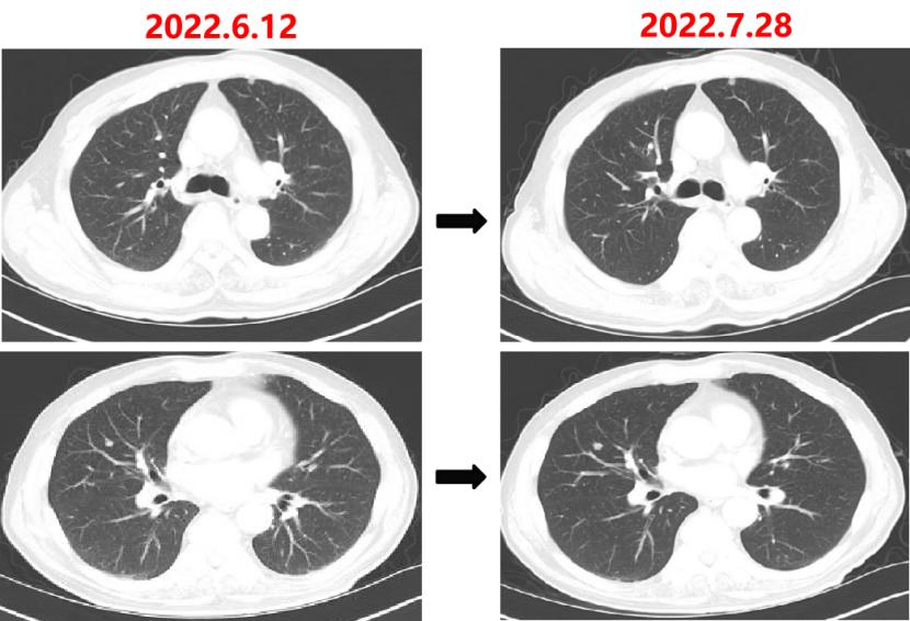 中国国内结直肠癌最新治疗,结直肠癌治好的可能性大吗