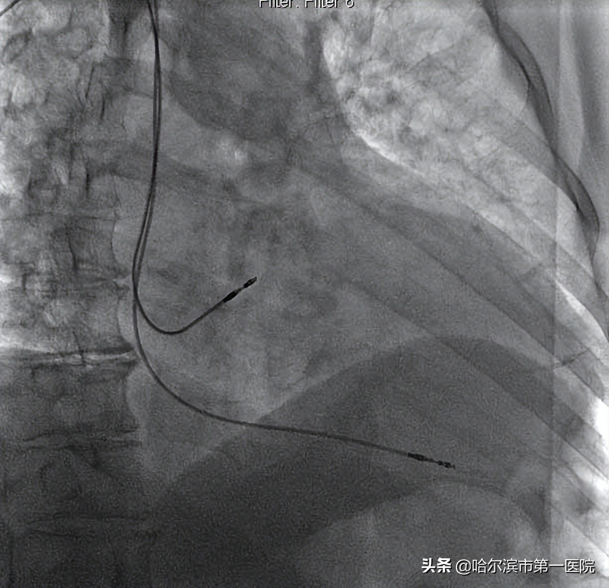 哈尔滨市第一医院心律失常起搏治疗开启新时代为高龄老人植入“抗核磁全自动超大电池容量”心脏双腔起搏器