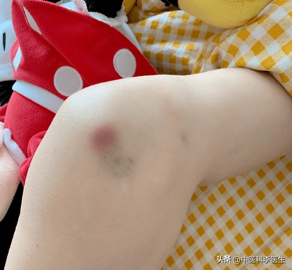 女人膝盖上的淤青怎么弄的,女人膝盖淤青