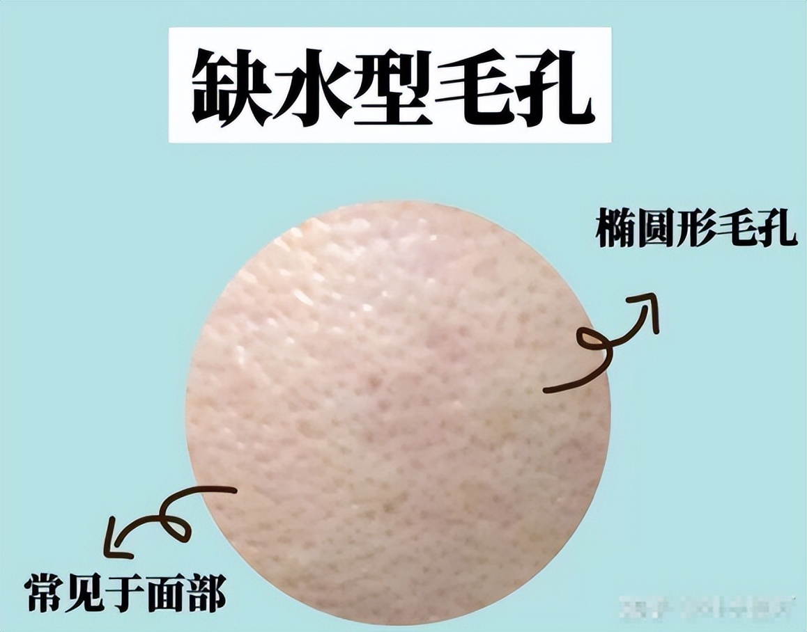 4种类型的毛孔粗大该怎么解决,怎样判断毛孔粗大的类型