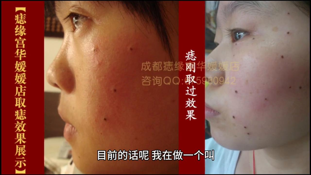 希君美祛痣几天脱落,希君美去痣有用吗