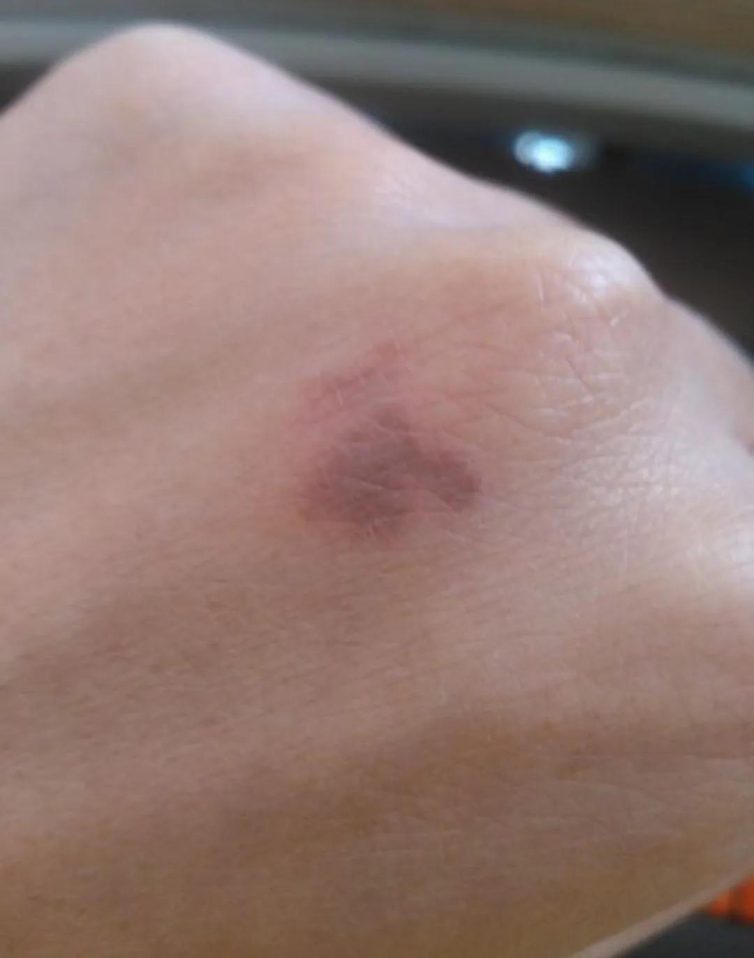 一两块钱的红霉素软膏很实用，能解决多种皮肤问题，早知道早受益