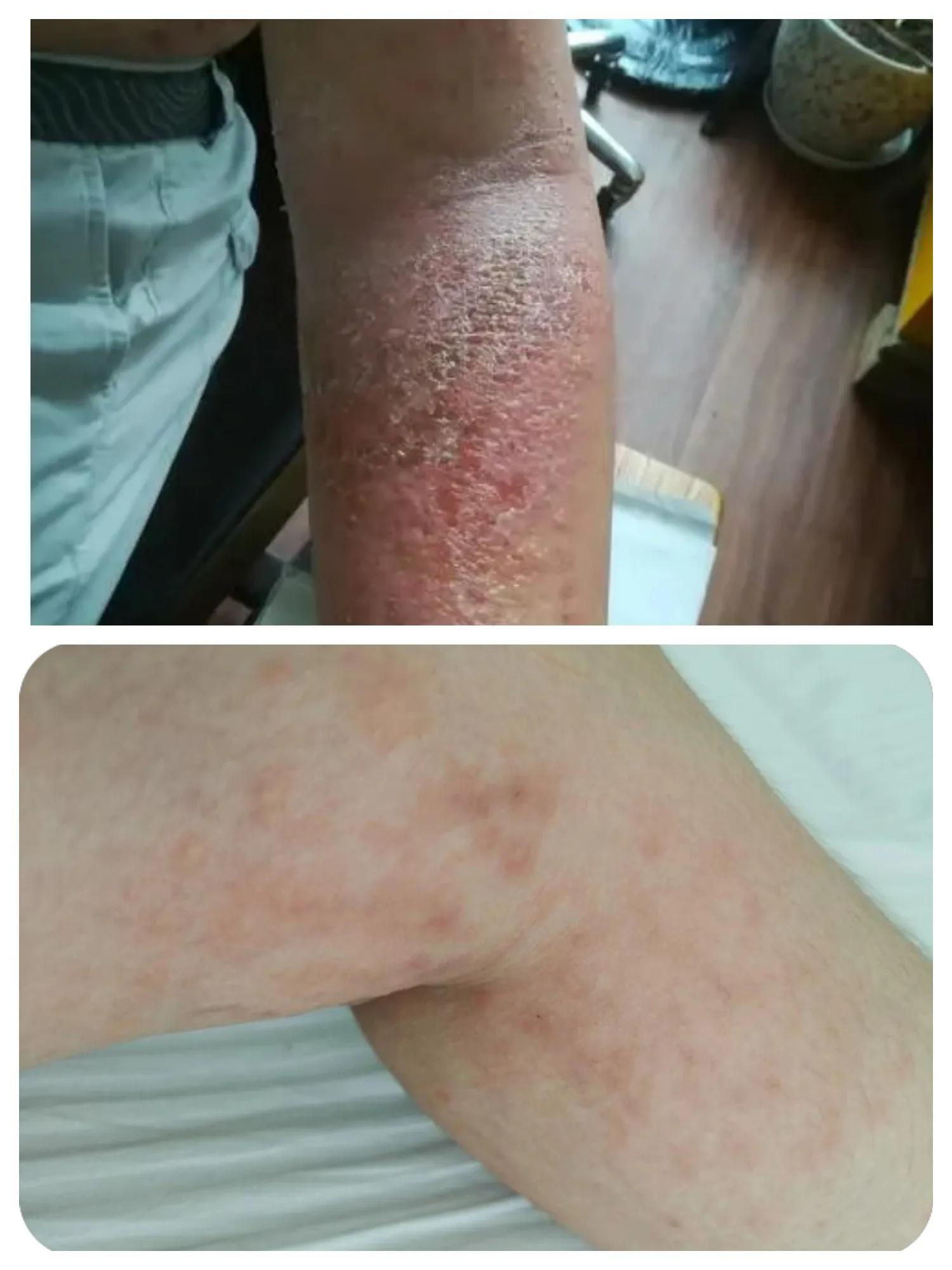 水疱型湿疹中药治疗,湿疹如何治疗发痒裂口