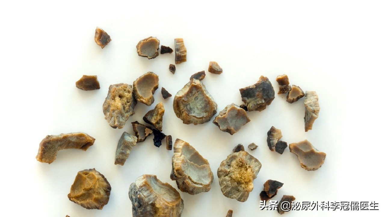 怎样能彻底根治尿结石,尿路结石怎么快速缓解尿意