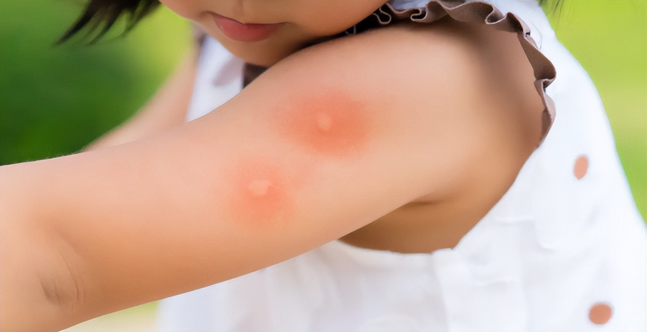 被蚊虫咬了一直反复痒如何处理,为什么被蚊虫咬了会红肿起泡